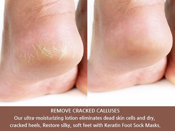 Epielle Hydrating Foot Masks (Socks 1pcs) for foot cracked and dry heel to toe and callus Spa Masks - Shea butter + Jojoba Oil + Vitamin E Moisturize, Mothers Day GIfts Made in Korea. 